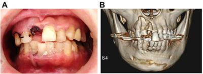 Case Report: Dental treatment for an oboist: Post-trauma prosthetic rehabilitation and evaluation of musical performance